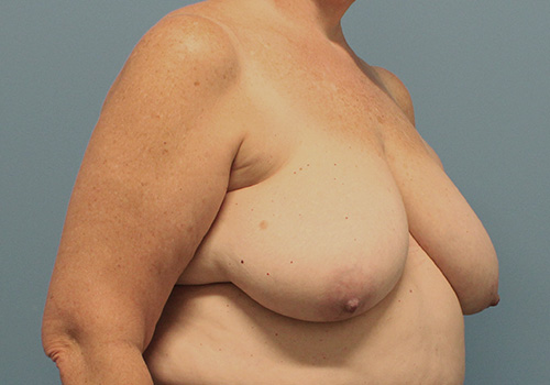 Breast Reduction Before and After | SGK Plastic Surgery