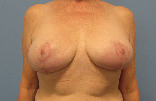 Breast Reduction Before and After | SGK Plastic Surgery