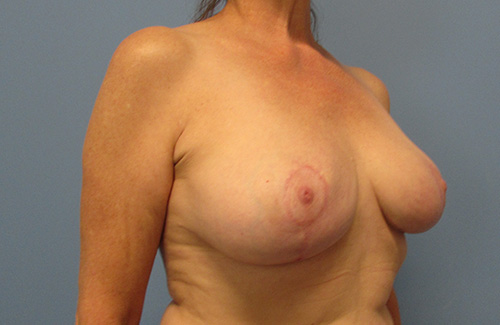 Breast Reduction Before and After | SGK Plastic Surgery