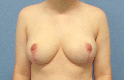 Breast Reduction Before and After | SGK Plastic Surgery