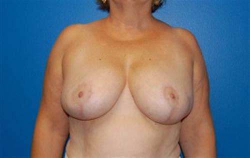 Breast Reduction Before and After | SGK Plastic Surgery