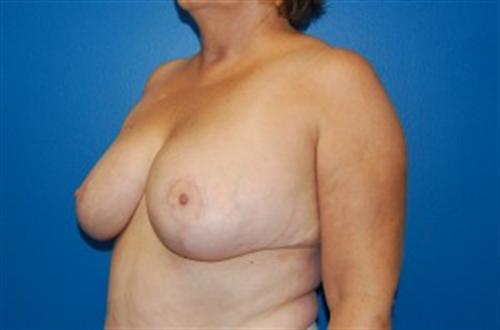 Breast Reduction Before and After | SGK Plastic Surgery