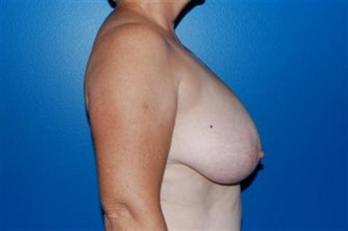 Breast Reduction Before and After | SGK Plastic Surgery