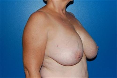 Breast Reduction Before and After | SGK Plastic Surgery