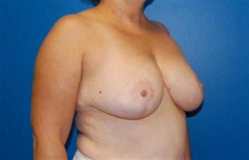 Breast Reduction Before and After | SGK Plastic Surgery