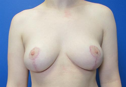 Breast Reduction Before and After | SGK Plastic Surgery