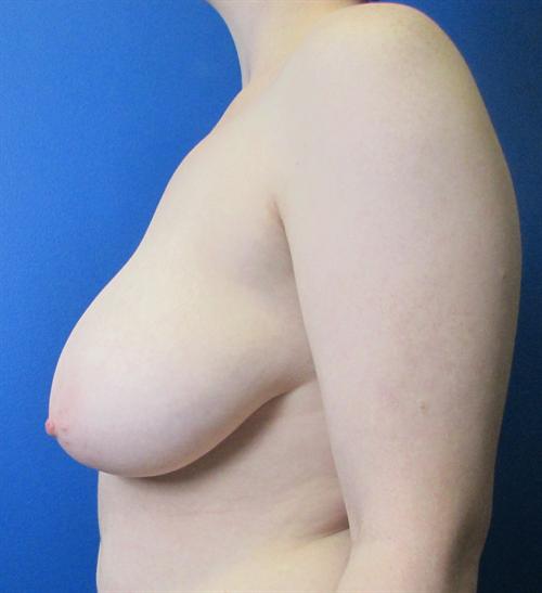 Breast Reduction Before and After | SGK Plastic Surgery