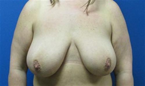 Breast Reduction Before and After | SGK Plastic Surgery