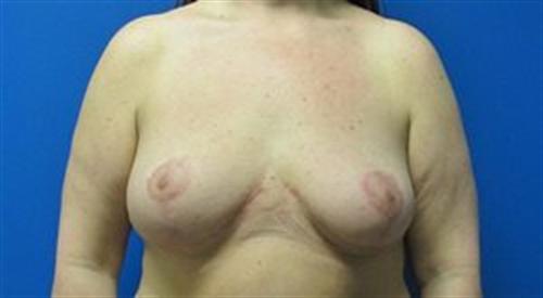 Breast Reduction Before and After | SGK Plastic Surgery