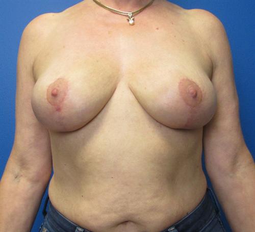 Breast Reduction Before and After | SGK Plastic Surgery