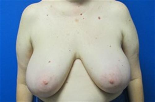 Breast Reduction Before and After | SGK Plastic Surgery