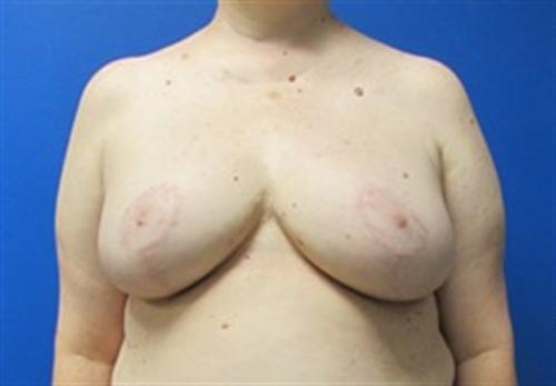 Breast Reduction Before and After | SGK Plastic Surgery