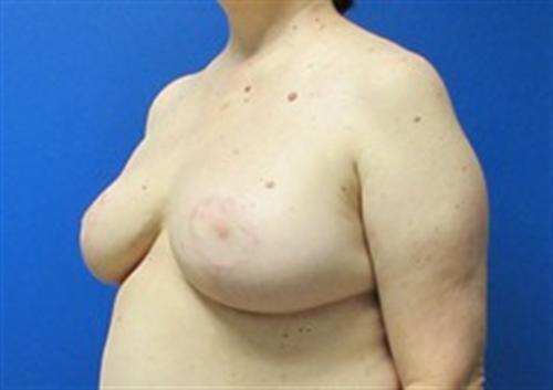 Breast Reduction Before and After | SGK Plastic Surgery