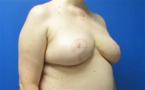 Breast Reduction Before and After | SGK Plastic Surgery