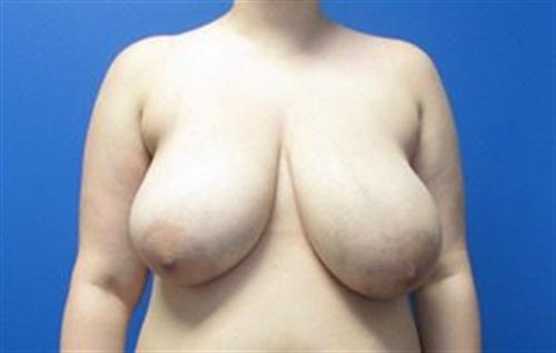 Breast Reduction Before and After | SGK Plastic Surgery