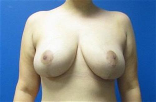 Breast Reduction Before and After | SGK Plastic Surgery