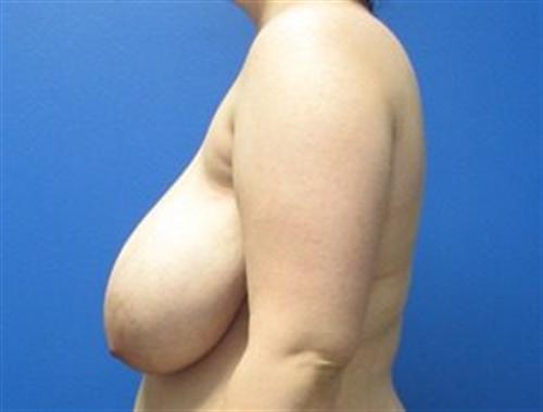 Breast Reduction Before and After | SGK Plastic Surgery