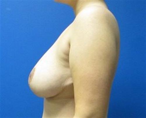 Breast Reduction Before and After | SGK Plastic Surgery