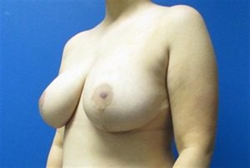 Breast Reduction Before and After | SGK Plastic Surgery