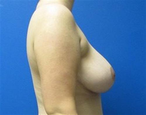 Breast Reduction Before and After | SGK Plastic Surgery