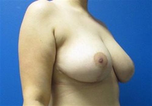 Breast Reduction Before and After | SGK Plastic Surgery