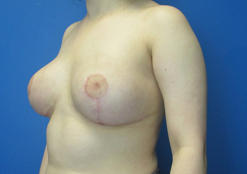 Breast Reduction Before and After | SGK Plastic Surgery