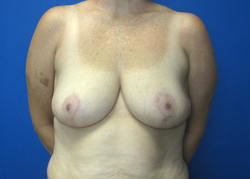 Breast Reduction Before and After | SGK Plastic Surgery