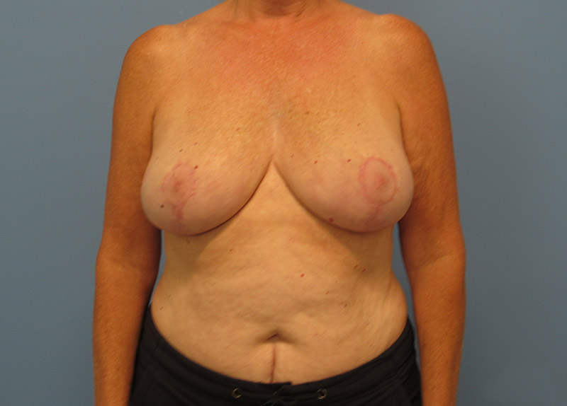 Breast Reduction Before and After | SGK Plastic Surgery