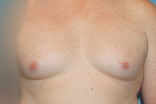 Male Breast Reduction The Woodlands