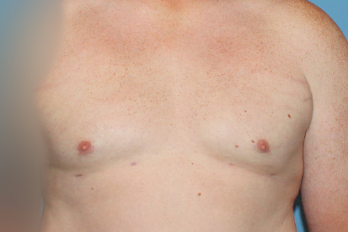 Gynecomastia Before and After | SGK Plastic Surgery