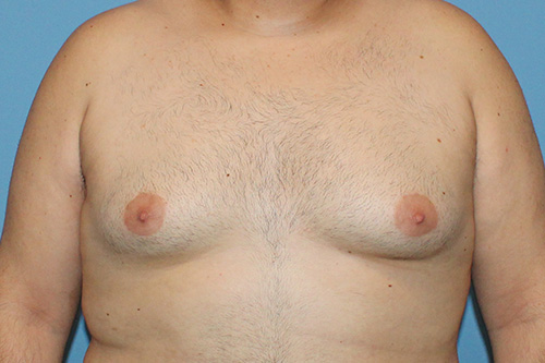 Male Breast Reduction The Woodlands