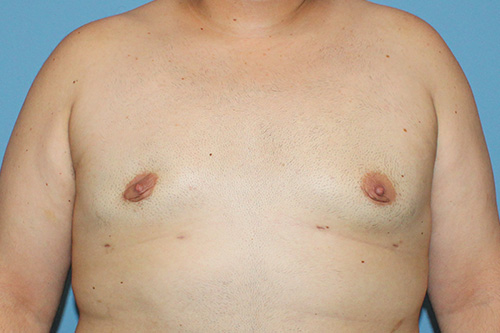 Male Breast Reduction The Woodlands