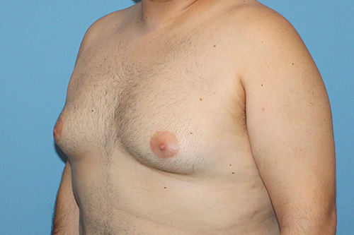 Gynecomastia Before and After | SGK Plastic Surgery