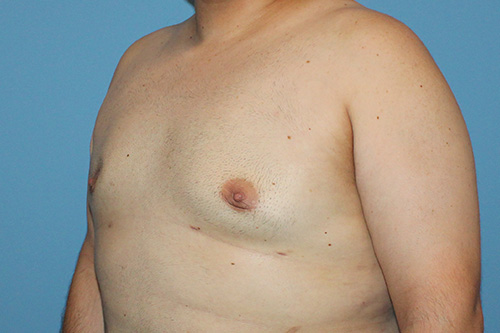 Gynecomastia Before and After | SGK Plastic Surgery