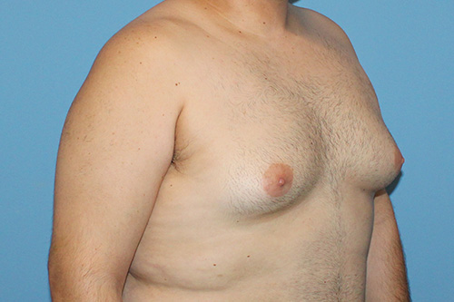 Gynecomastia Before and After | SGK Plastic Surgery