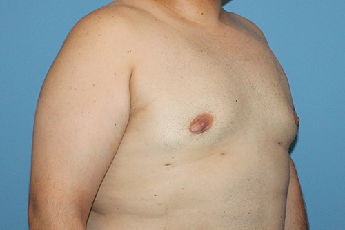 Gynecomastia Before and After | SGK Plastic Surgery