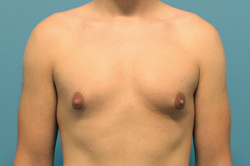 Gynecomastia Before and After | SGK Plastic Surgery