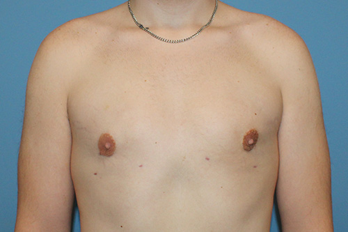 Gynecomastia Before and After | SGK Plastic Surgery