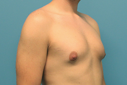 Gynecomastia Before and After | SGK Plastic Surgery