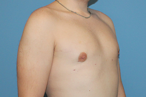 Gynecomastia Before and After | SGK Plastic Surgery