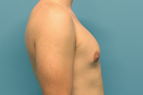 Gynecomastia Before and After | SGK Plastic Surgery