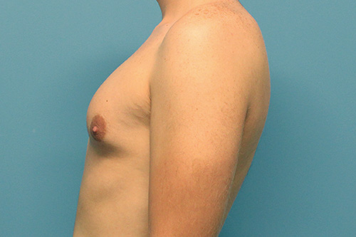 Gynecomastia Before and After | SGK Plastic Surgery