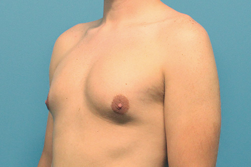 Gynecomastia Before and After | SGK Plastic Surgery