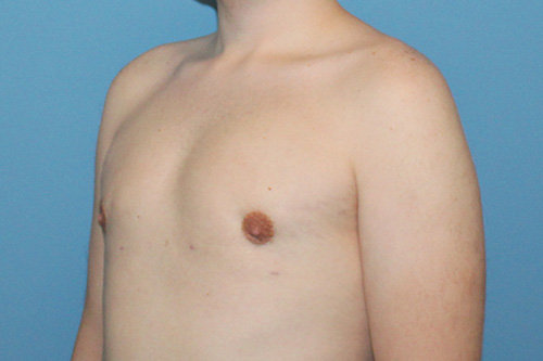 Gynecomastia Before and After | SGK Plastic Surgery