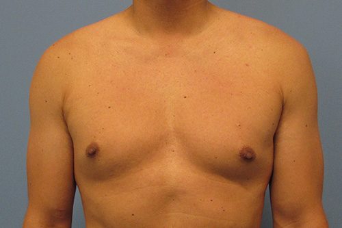 Gynecomastia Before and After | SGK Plastic Surgery