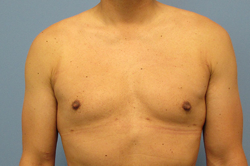 Gynecomastia Before and After | SGK Plastic Surgery