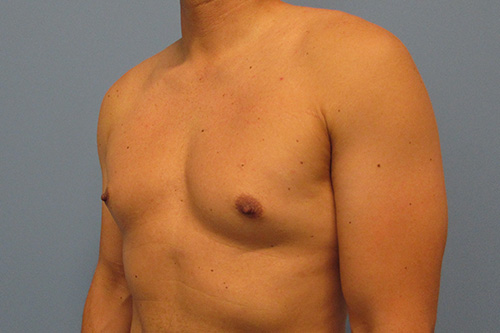 Gynecomastia Before and After | SGK Plastic Surgery