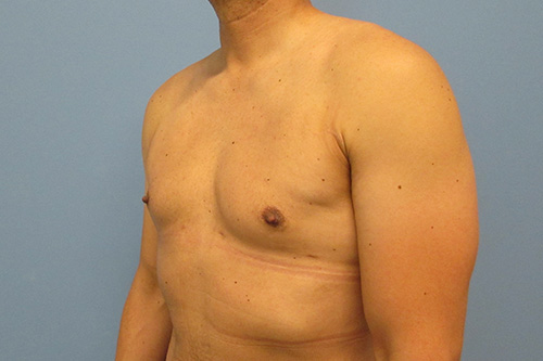 Gynecomastia Before and After | SGK Plastic Surgery