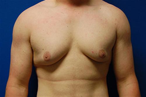 Gynecomastia Before and After | SGK Plastic Surgery