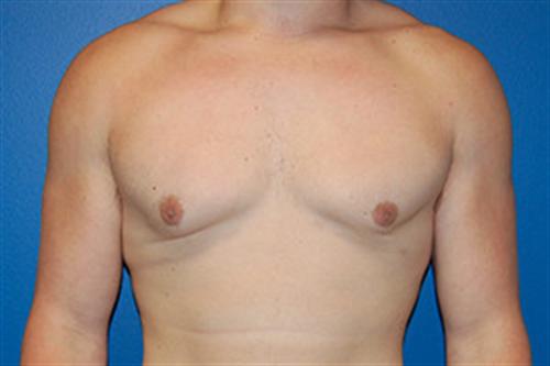 Gynecomastia Before and After | SGK Plastic Surgery